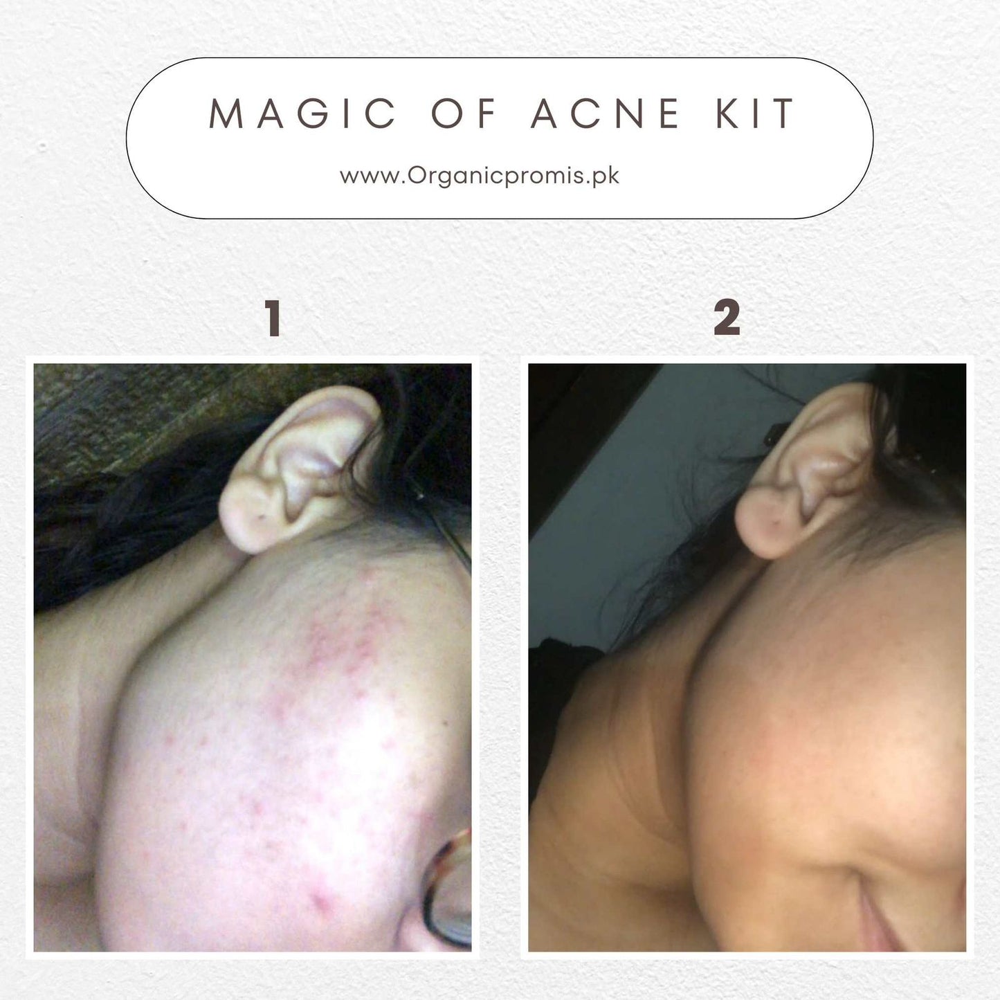 Acne Control Bundle Lite