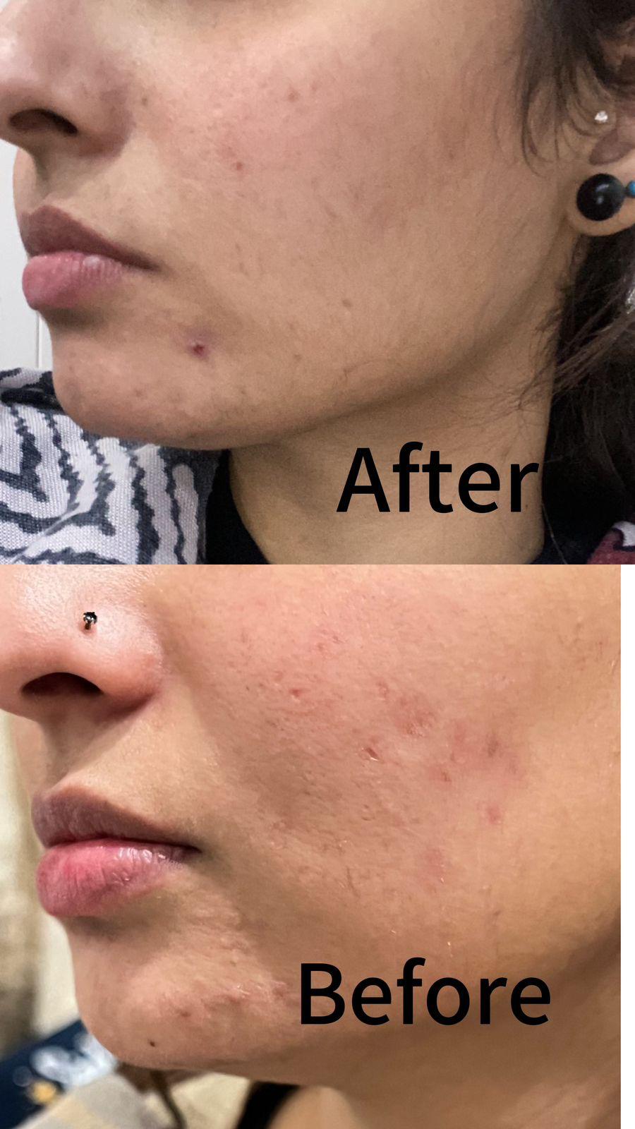 Acne Control Treatment - 2 % Salicylic acid Organic Promise By Musarat