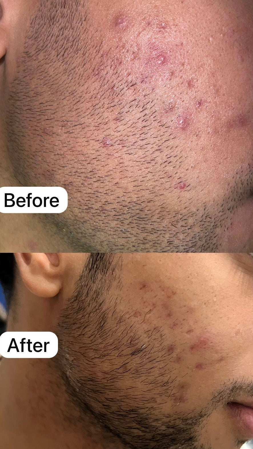 Acne Control Treatment - 2 % Salicylic acid Organic Promise By Musarat